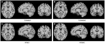 Identifying Type 2 Diabetic Brains by Investigating Disease-Related Structural Changes in Magnetic Resonance Imaging